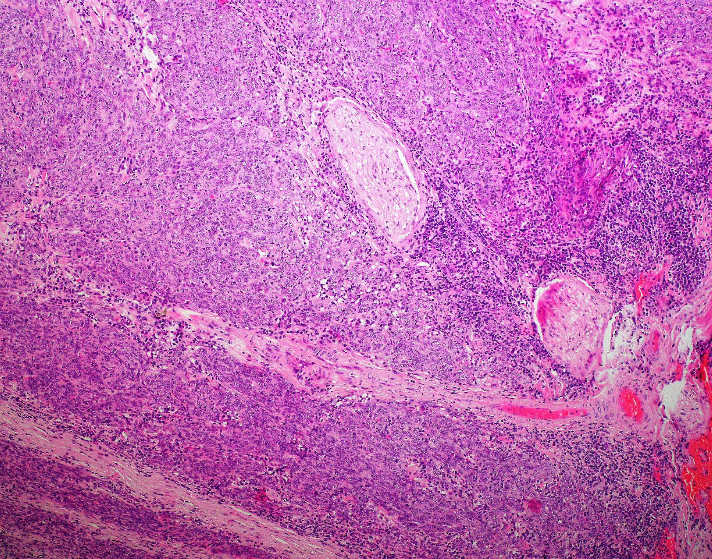 Poorly Differentiated Squamous Cell Carcinoma Of The Larynx With Extensive Perineural Invasion 