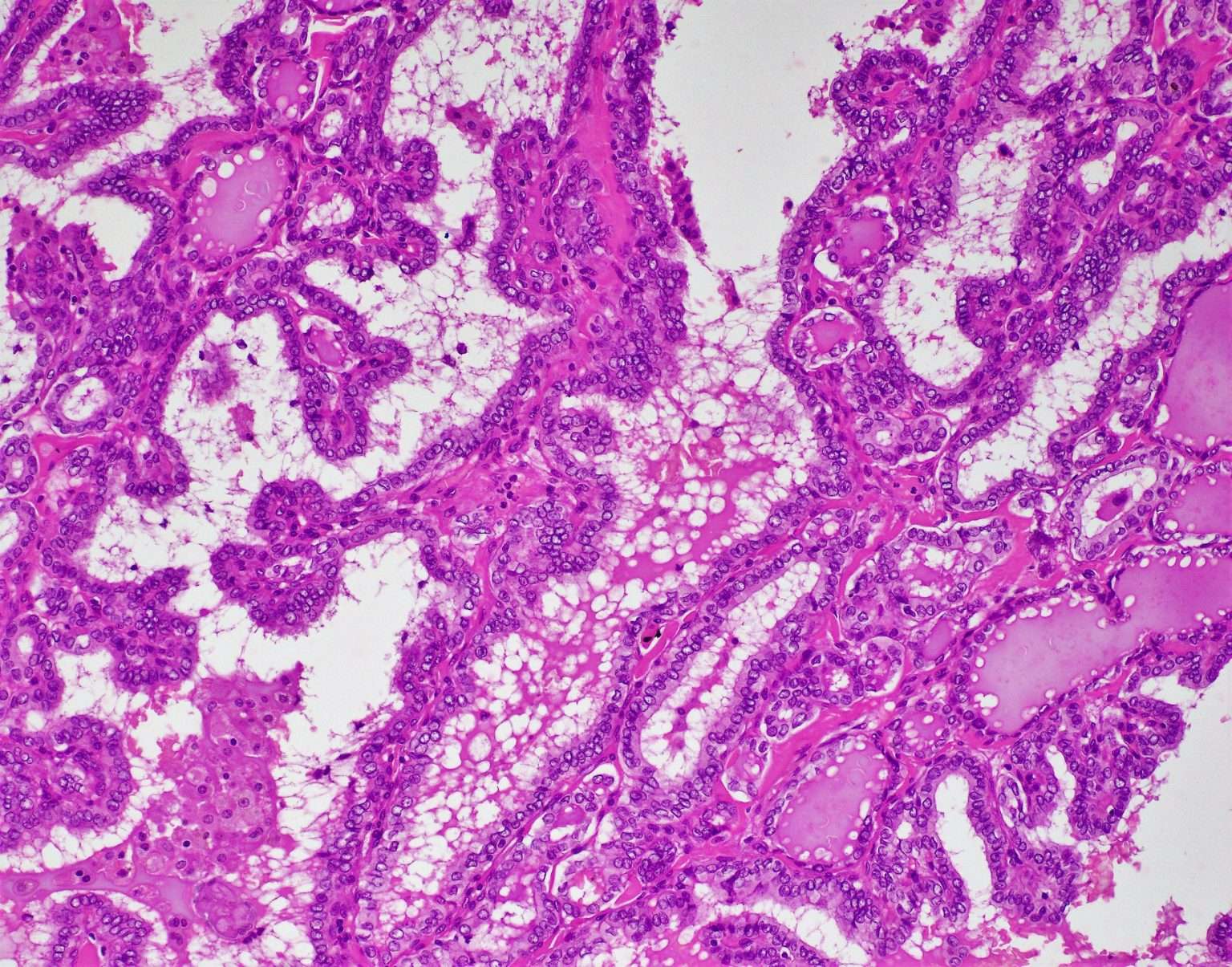 Papillary thyroid carcinoma – BosnianPathology