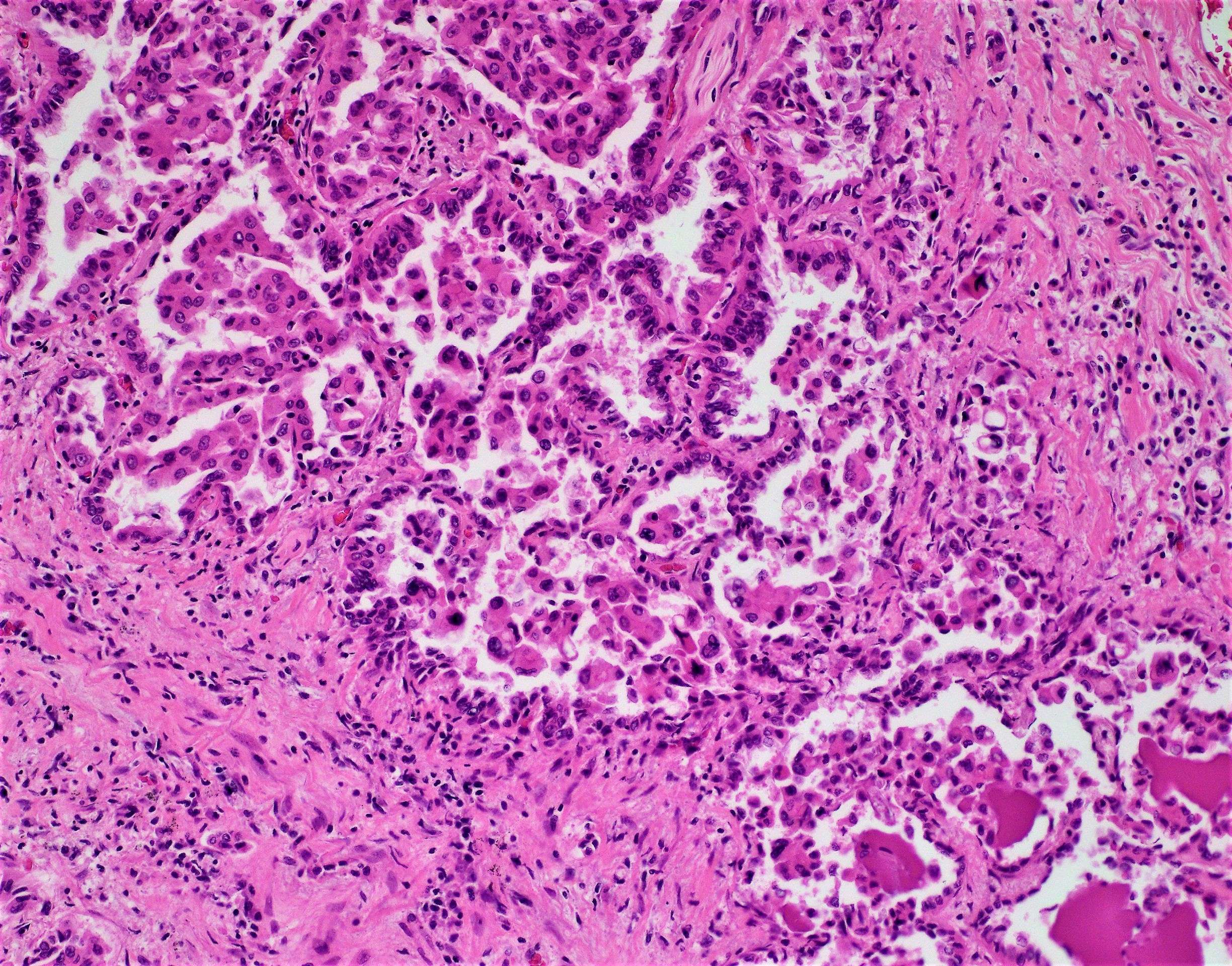 Pulmonary adenocarcinoma – BosnianPathology